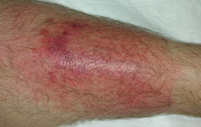 Celulite infecciosa